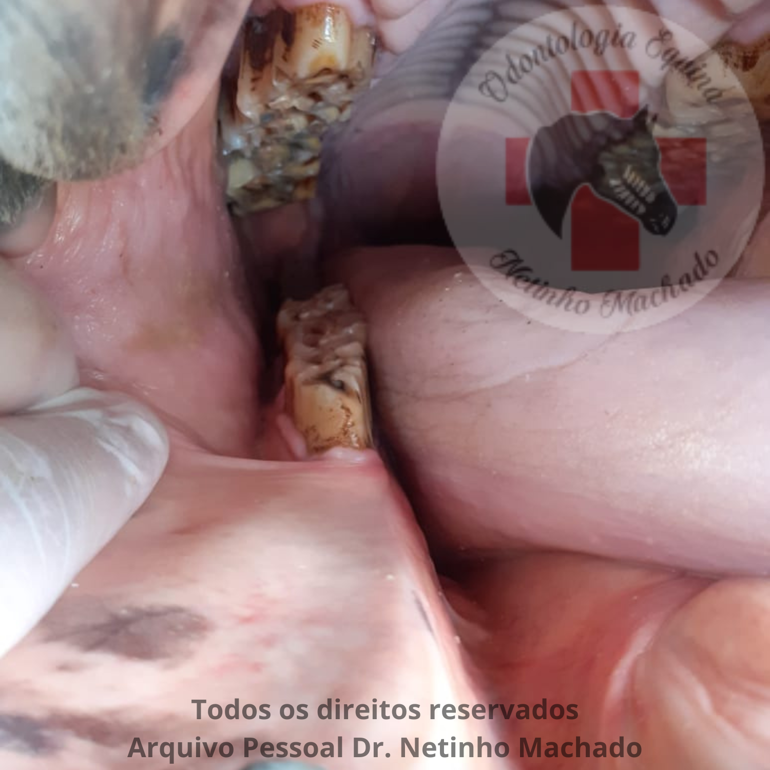 Degrau dentário.png